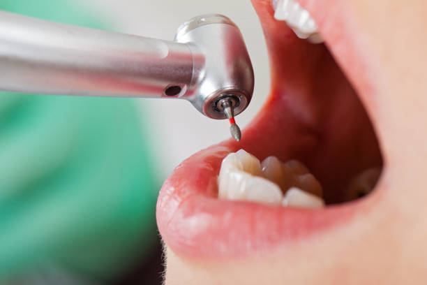 Best Dentist for Tooth Abscess  in Ellinwood, KS